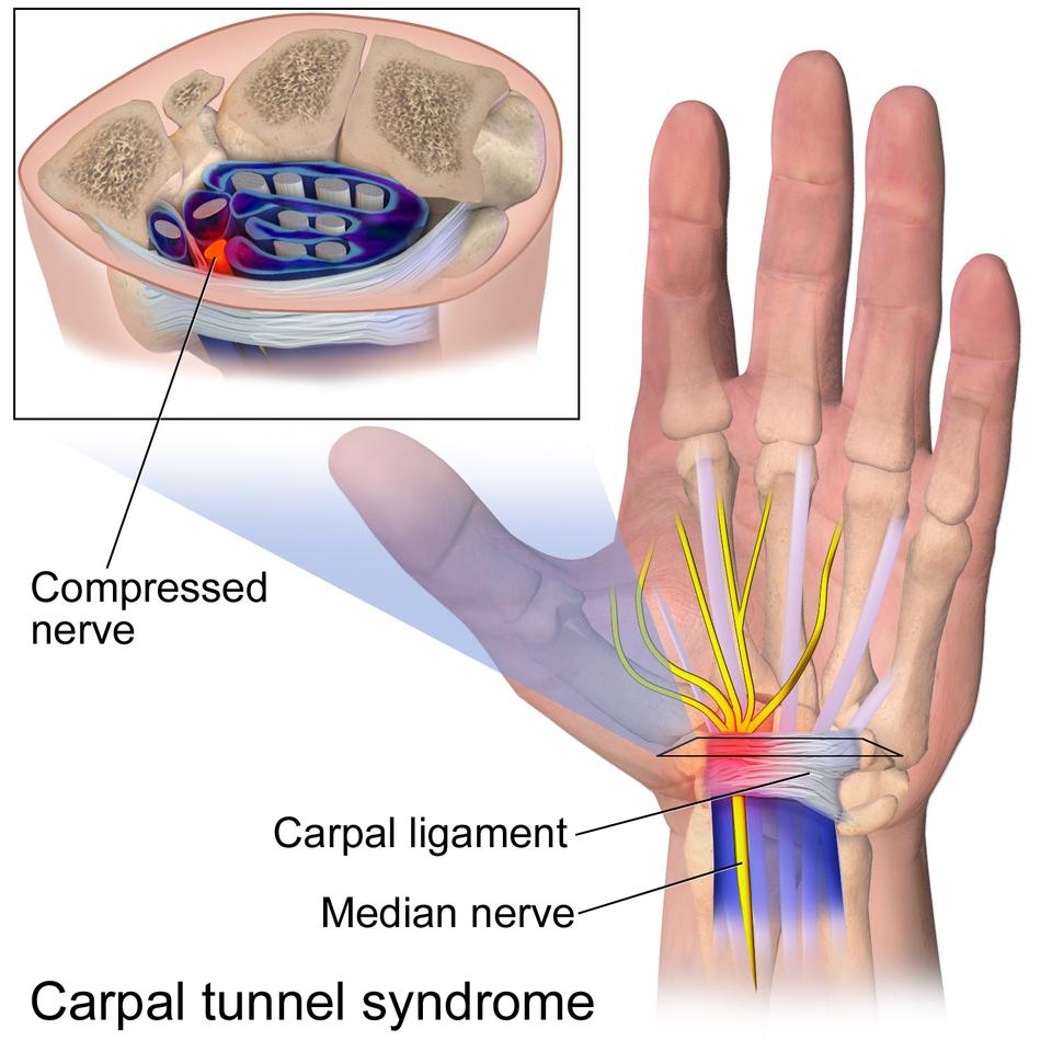 PRP treatment for carpal tunnel syndrome in Kochi - Regencare