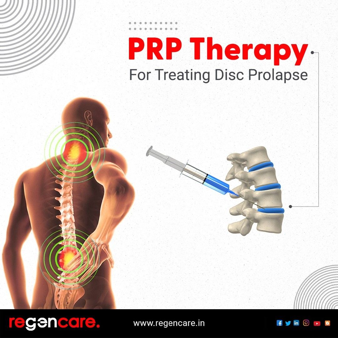 PRP Therapy For Treating Disc Prolapse