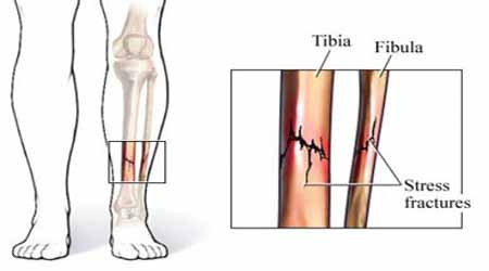 PRP treatment for stress fracture in Kochi - Regencare